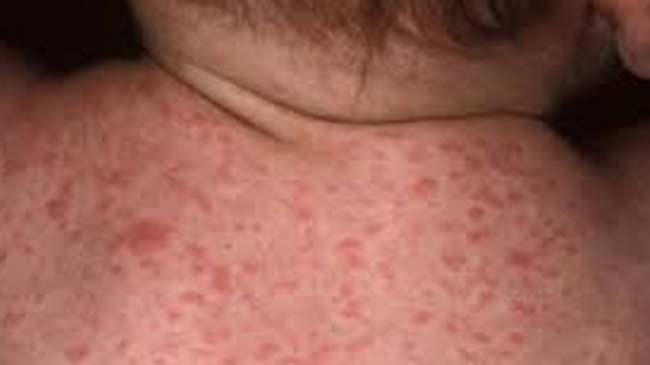 कञ्चनपुरको शुक्लाफाँटाका दुई बालकमा दादुरा–रुबेला