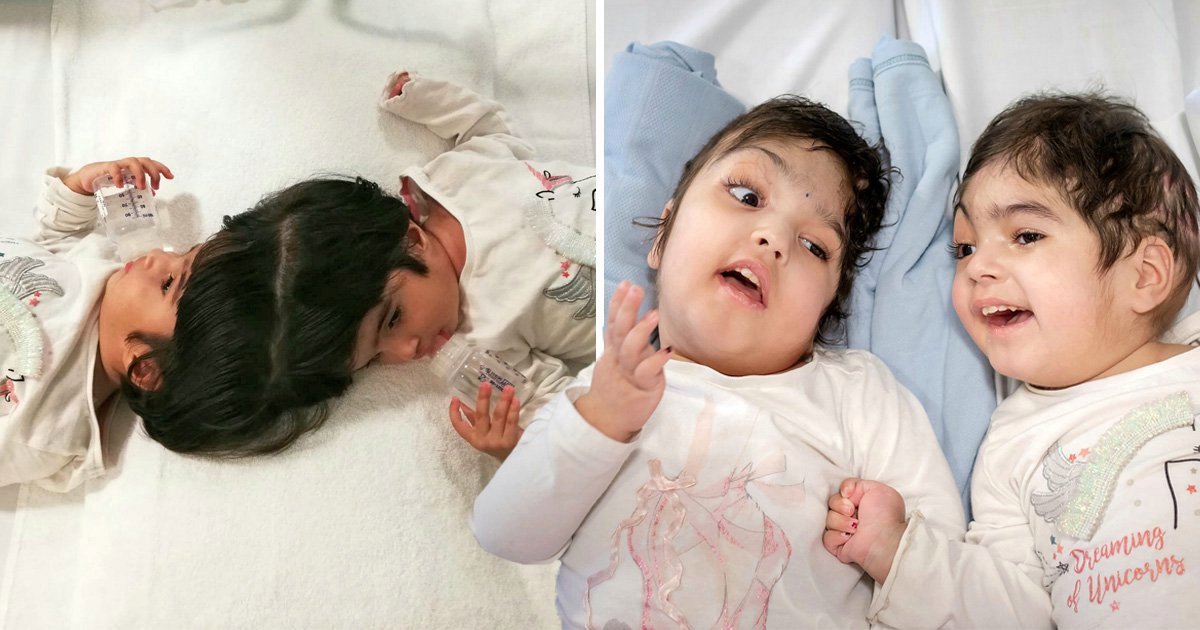 टाउको जोडिएर जन्मिएका जुम्ल्याहा सफल अपरेसन